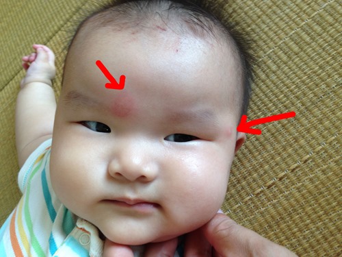 生後6ヶ月娘の顔に湿疹 勝手にライトニング